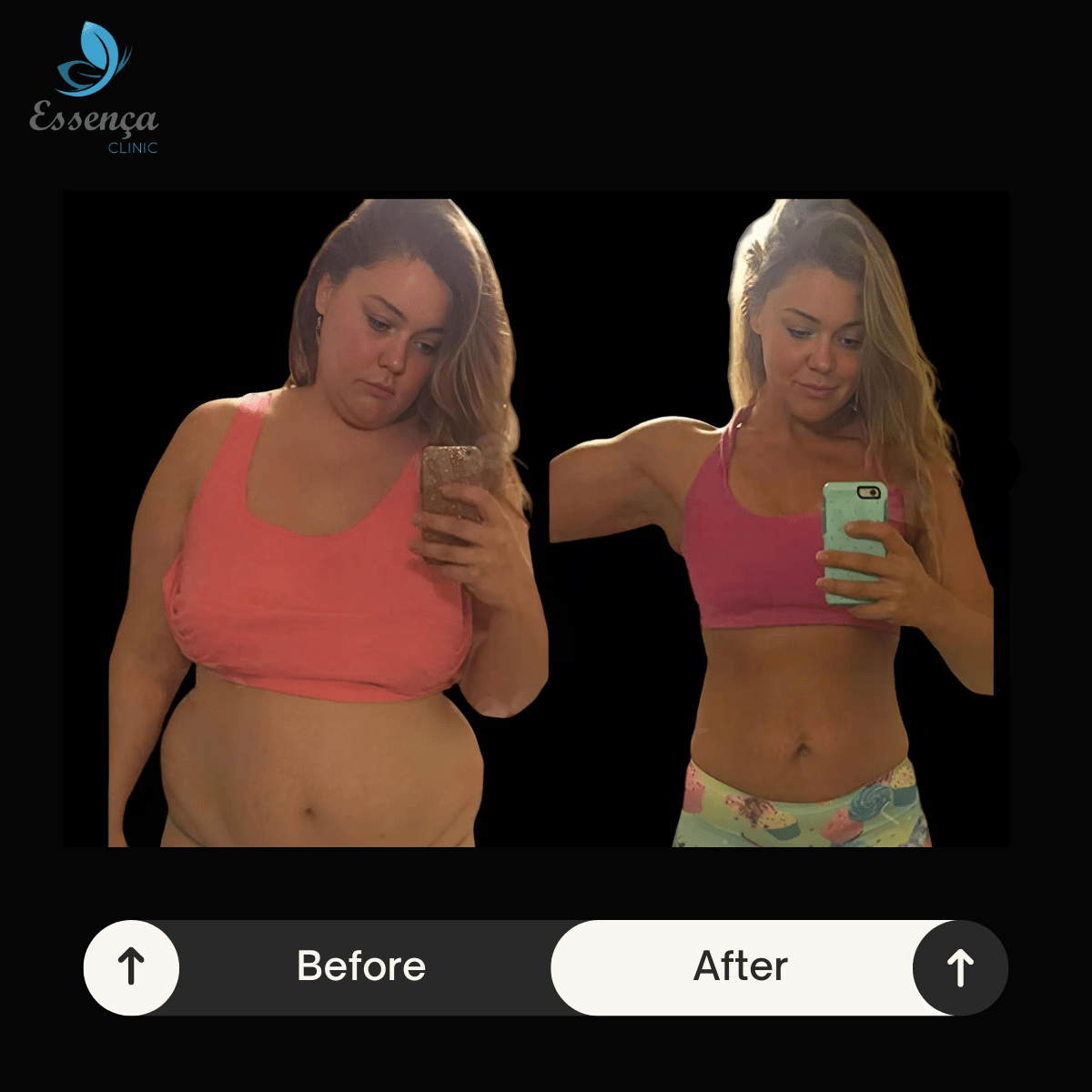 Before After Dr. Vahit Mutlu (4)-min