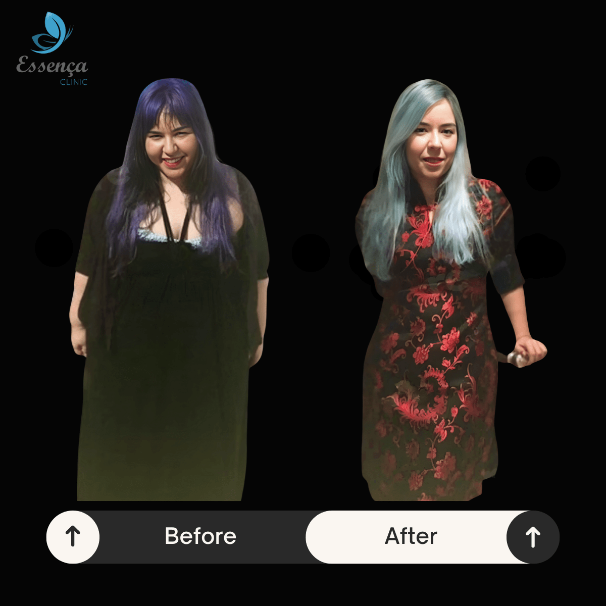 Before After Dr. Vahit Mutlu (8)-min
