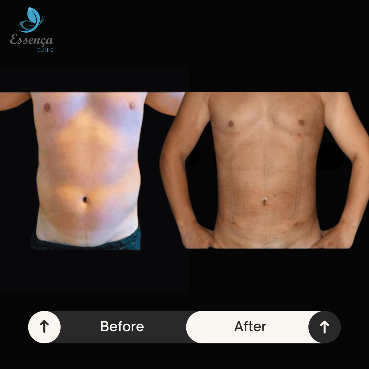 Body Shaping - Liposuction (1)-min