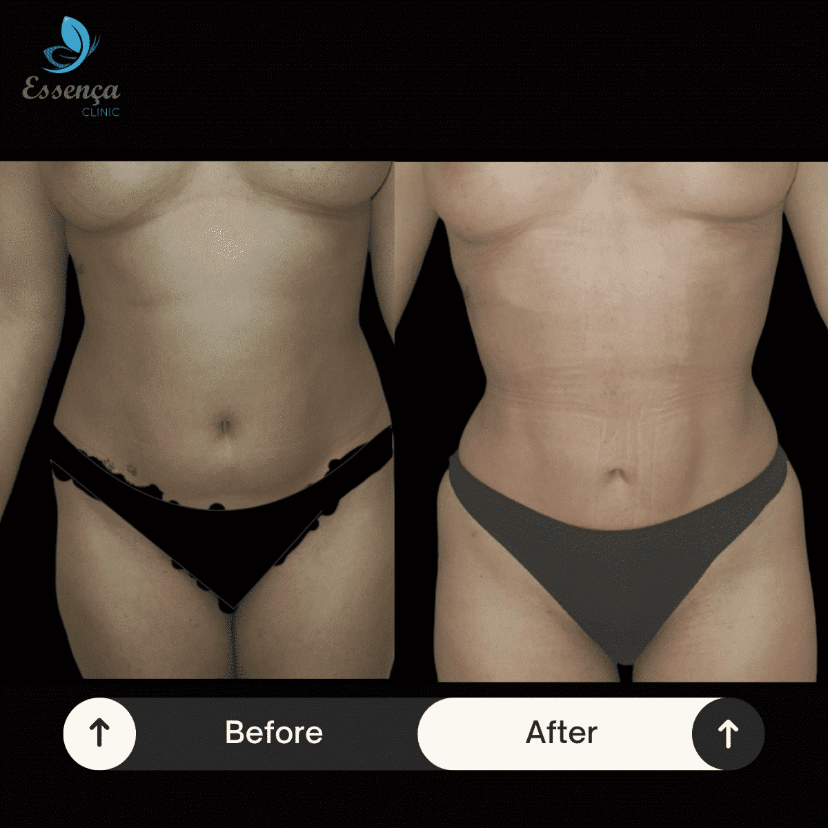 Body Shaping - Liposuction (10)-min