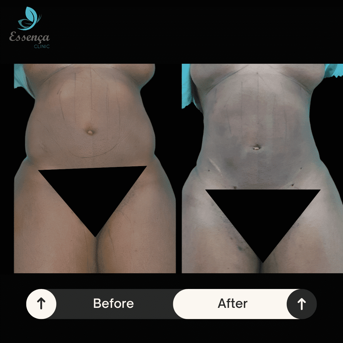 Body Shaping - Liposuction (11)-min