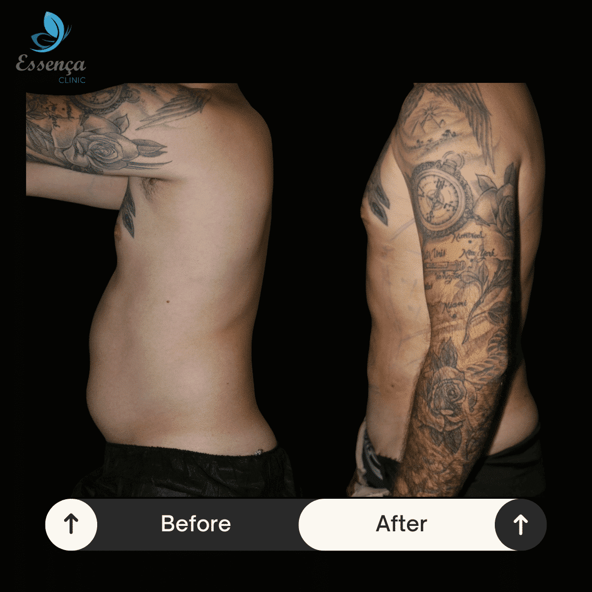 Body Shaping - Liposuction (15)-min