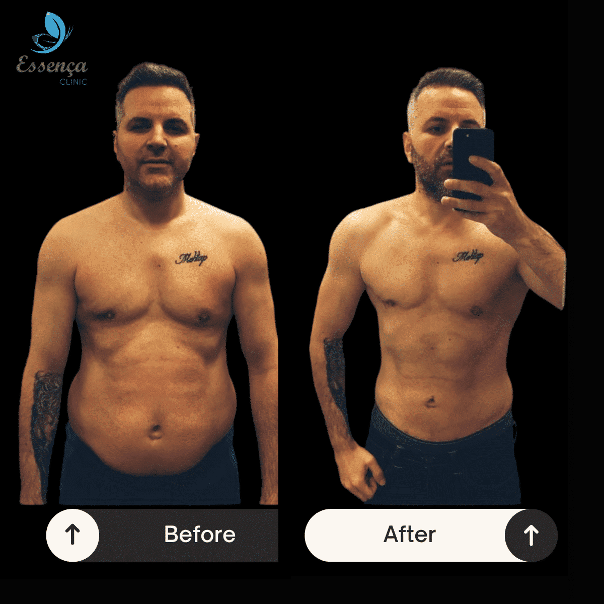 Body Shaping - Liposuction (17)-min
