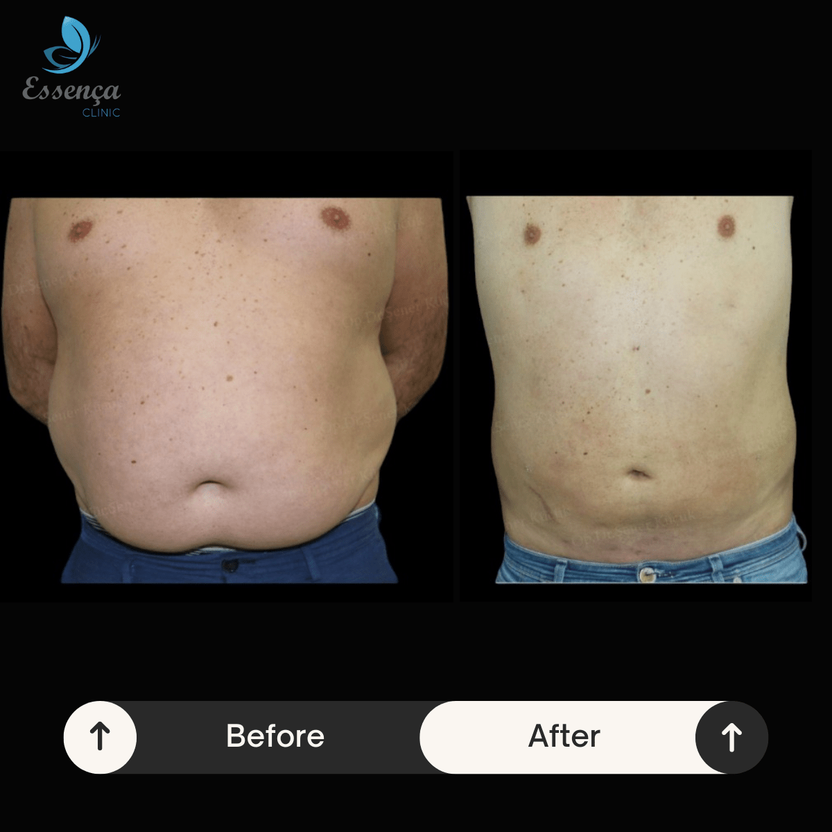 Body Shaping - Liposuction (2)-min