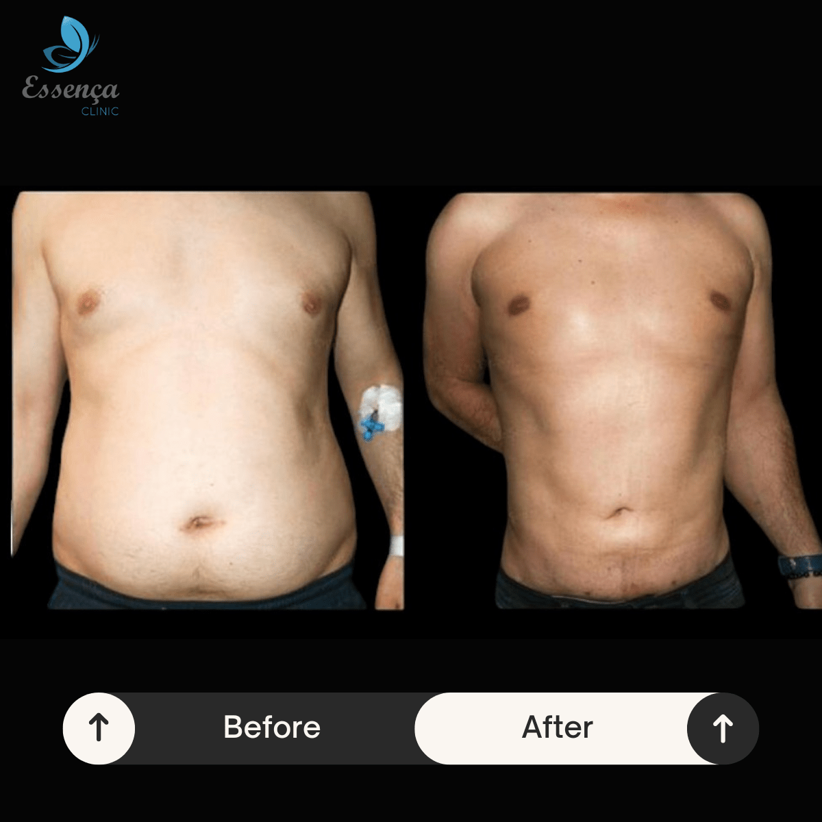 Body Shaping - Liposuction (4)-min