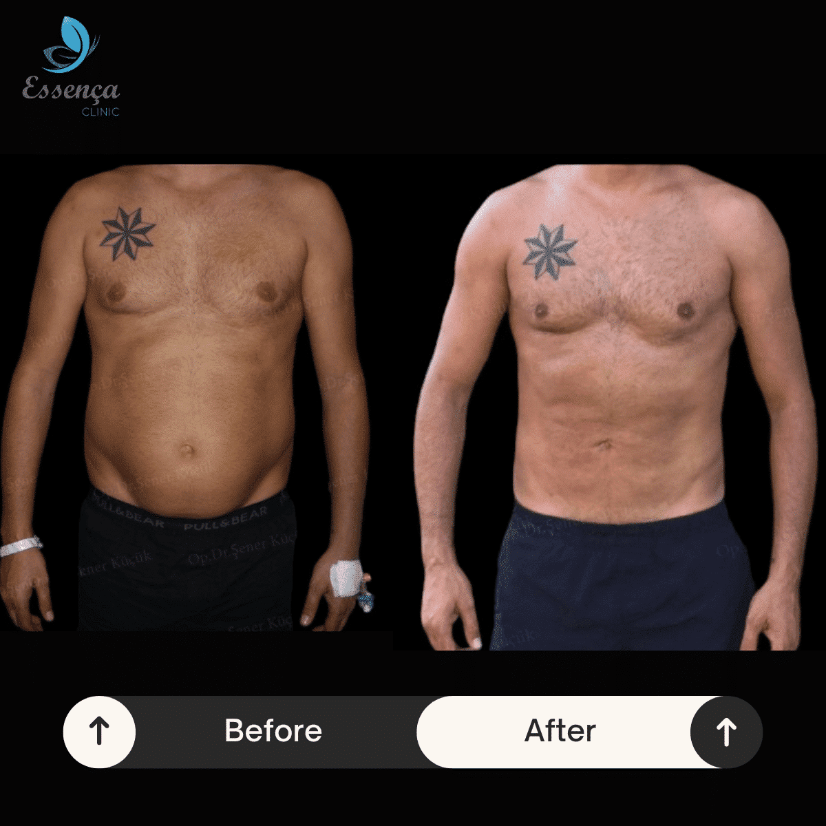 Body Shaping - Liposuction (5)-min