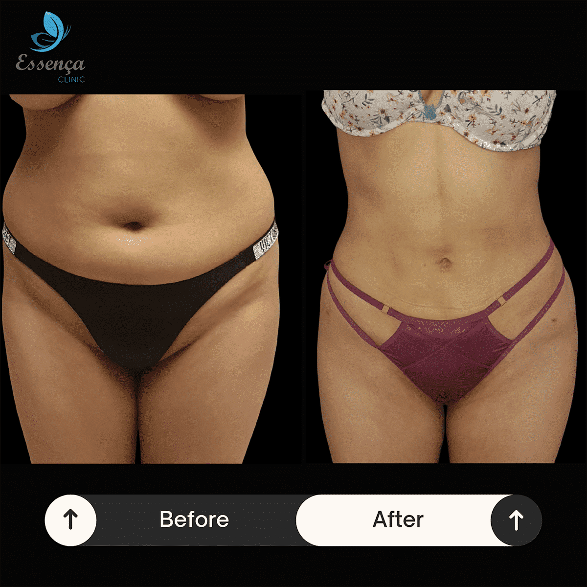 Body Shaping - Liposuction (8)-min