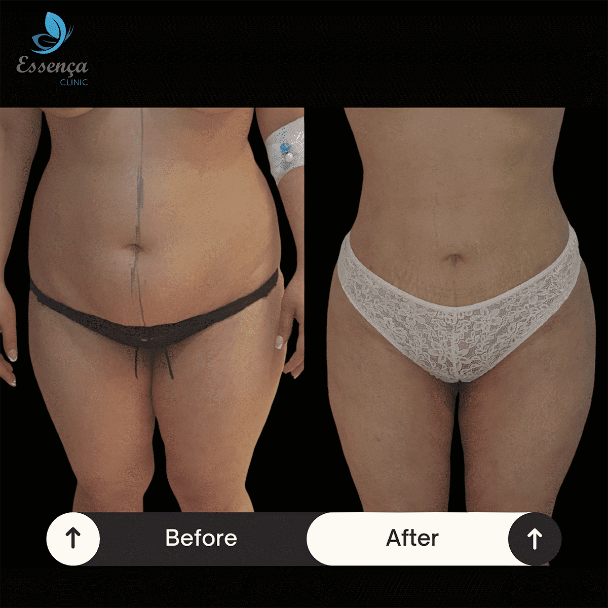 Body Shaping - Liposuction (9)-min
