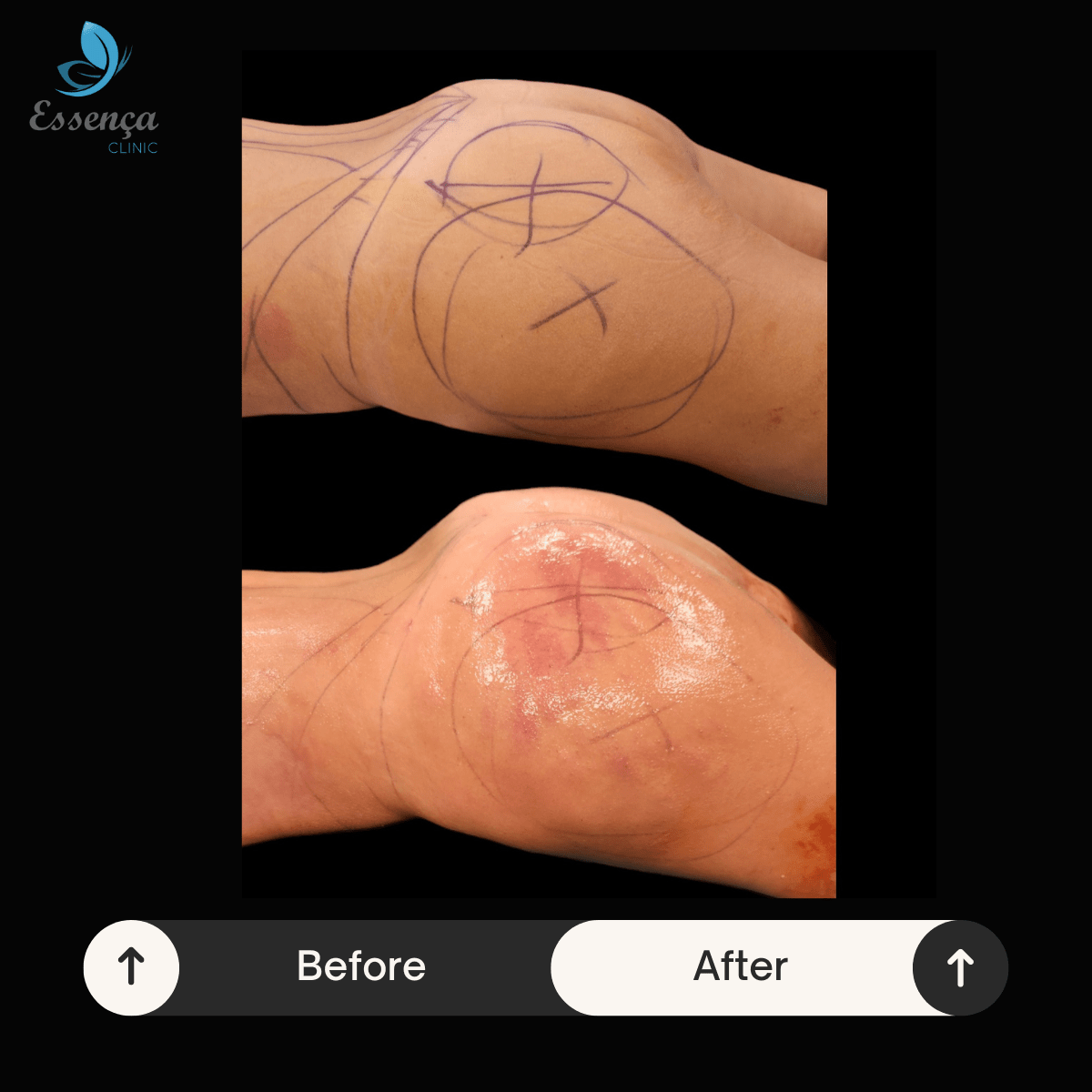 Brazilian Butt Lift (10)-min