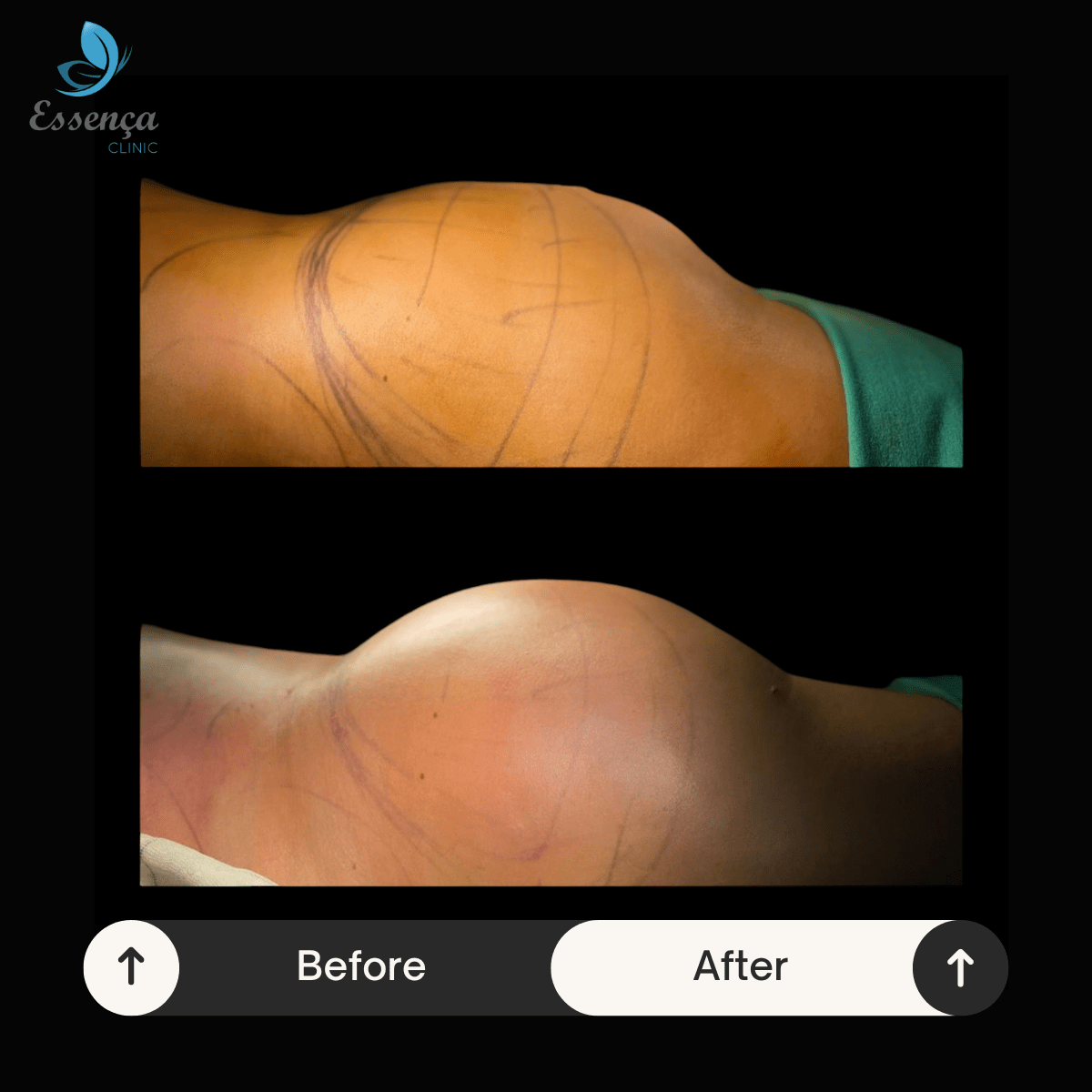 Brazilian Butt Lift (4)-min