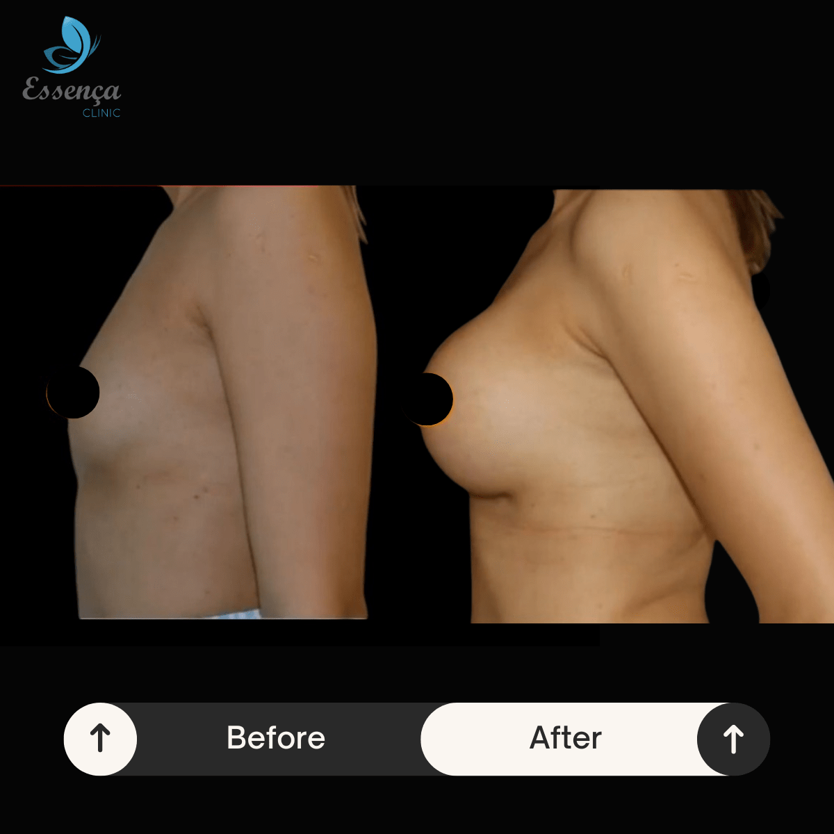 Breast Surgery (14)-min