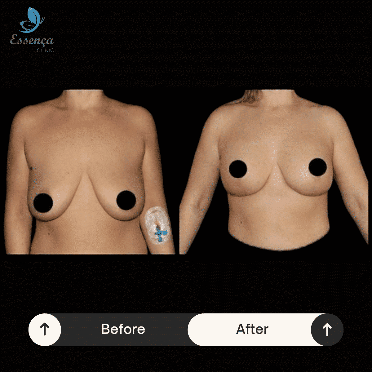 Breast Surgery (17)-min