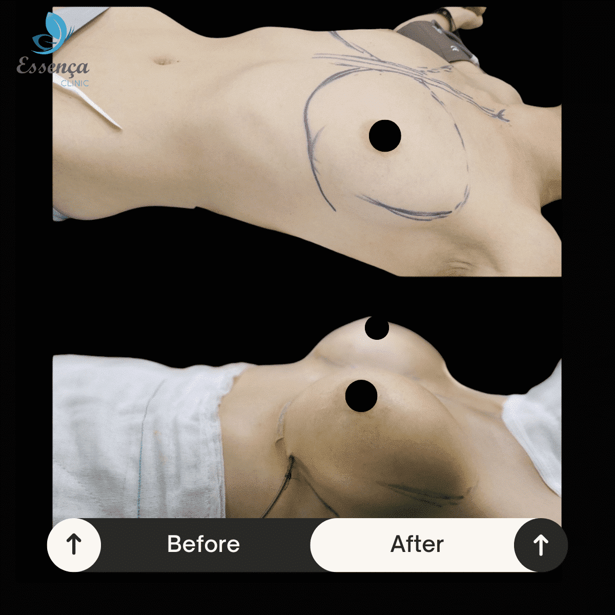 Breast Surgery (28)-min