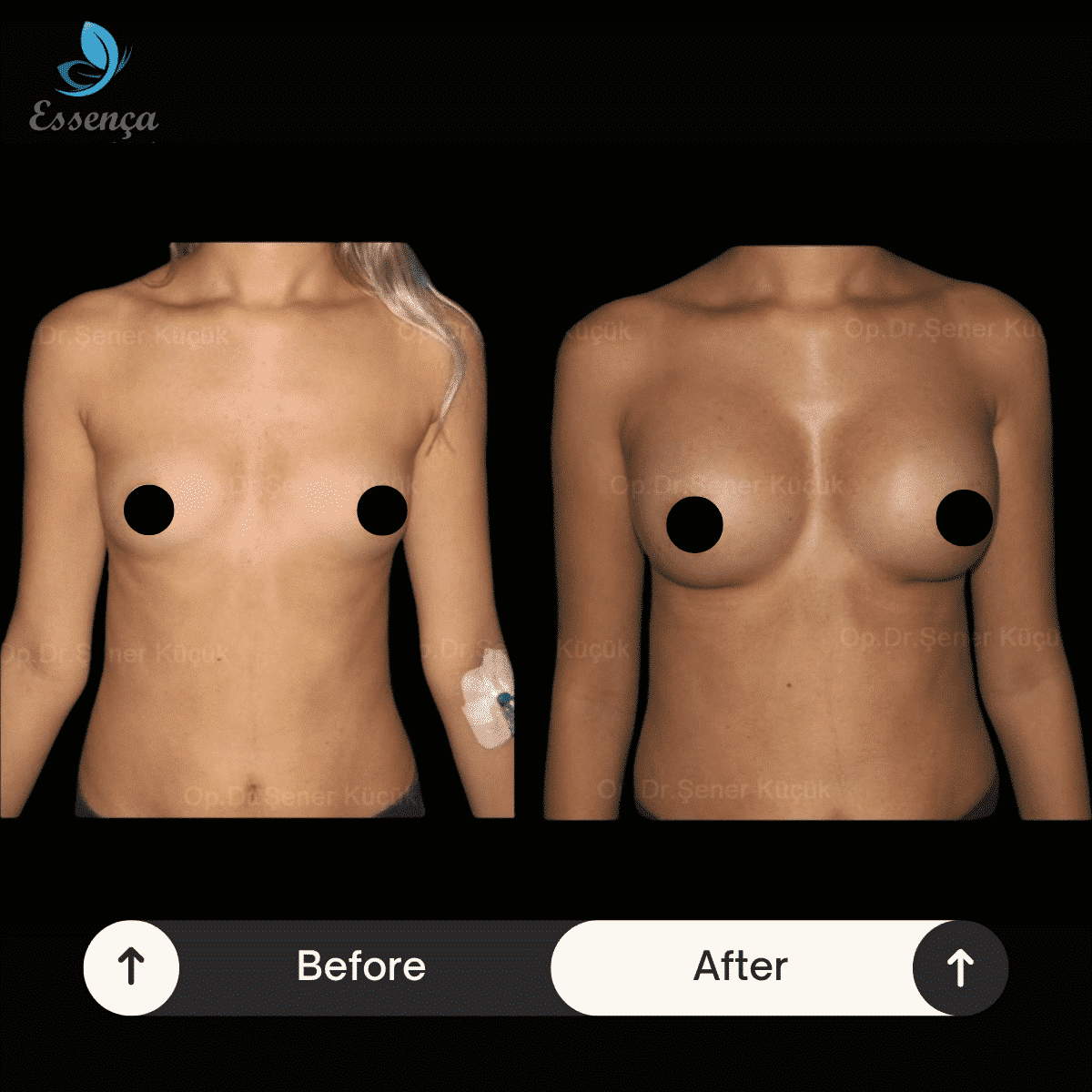Breast Surgery (4)-min