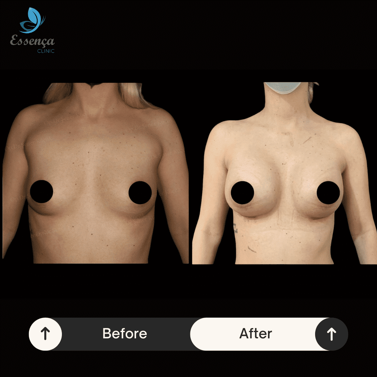 Breast Surgery (7)-min