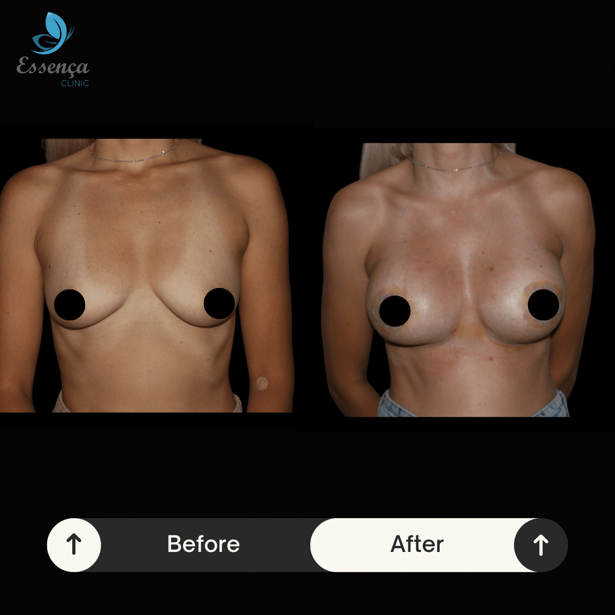 Breast Surgery (9)-min