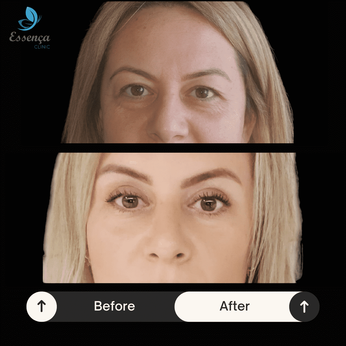 Eyelid Surgery (1)-min