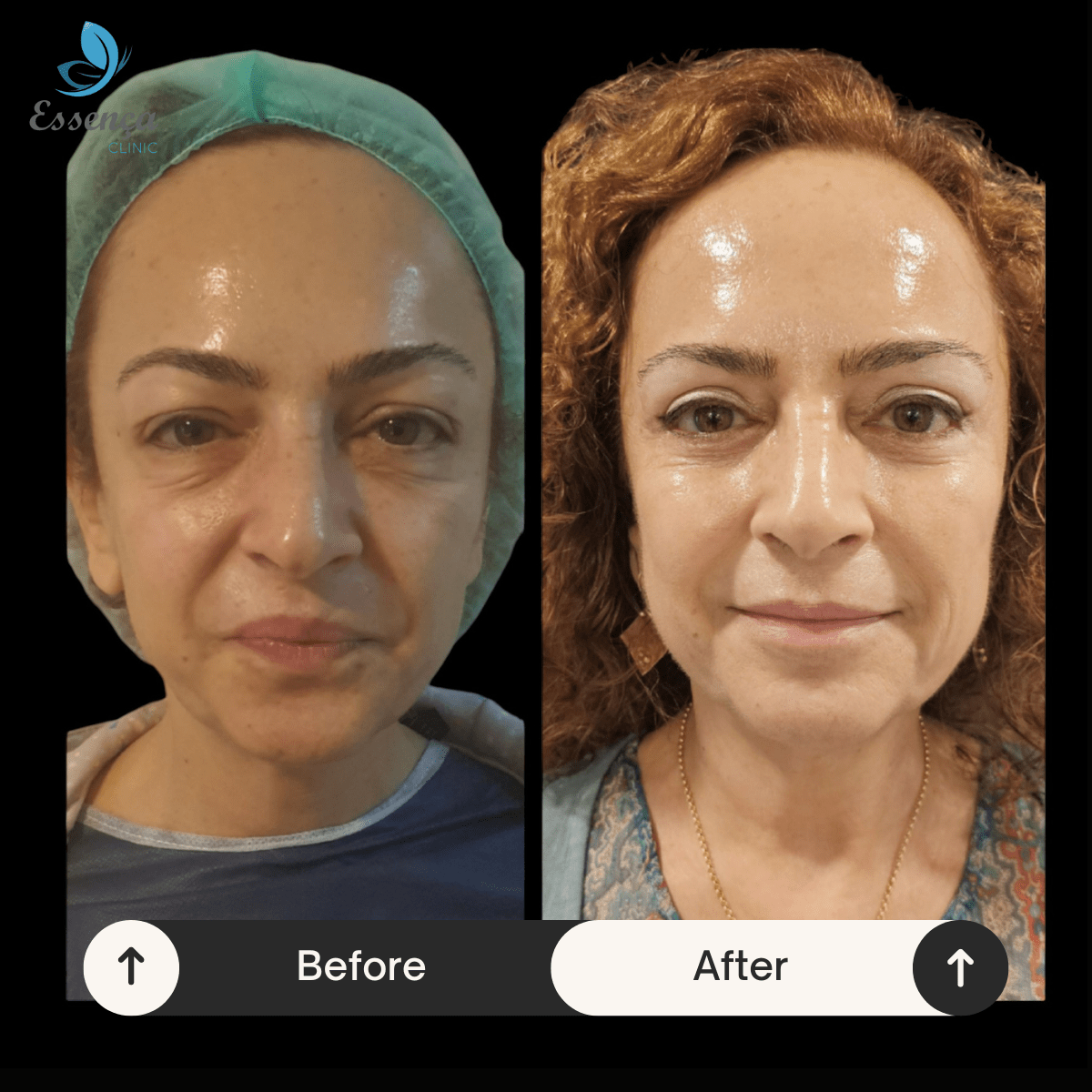Eyelid Surgery (4)-min