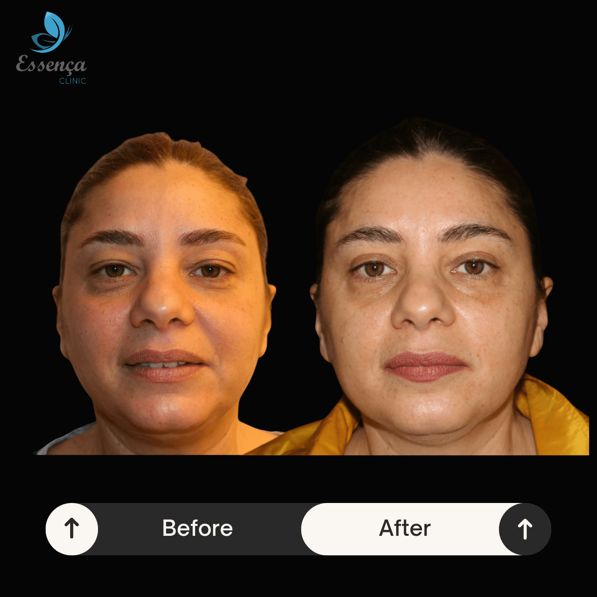 Eyelid Surgery (5)-min