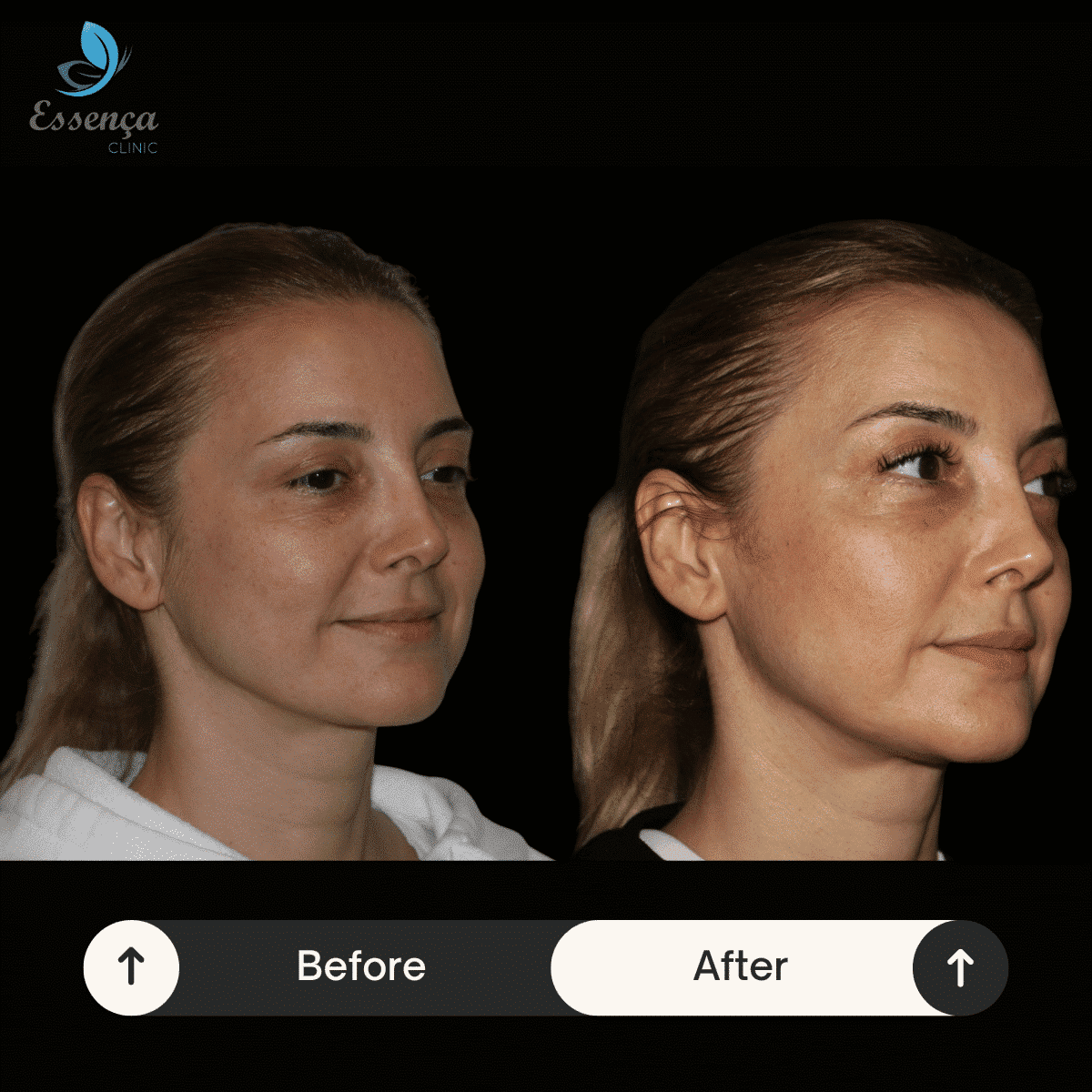 Eyelid Surgery (6)-min