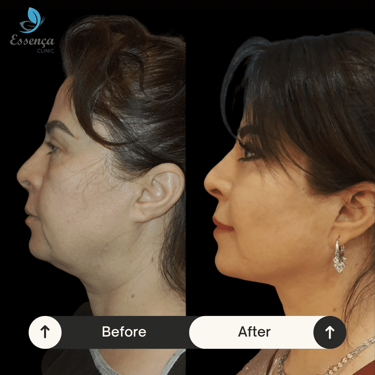 Face Lift (1)-min