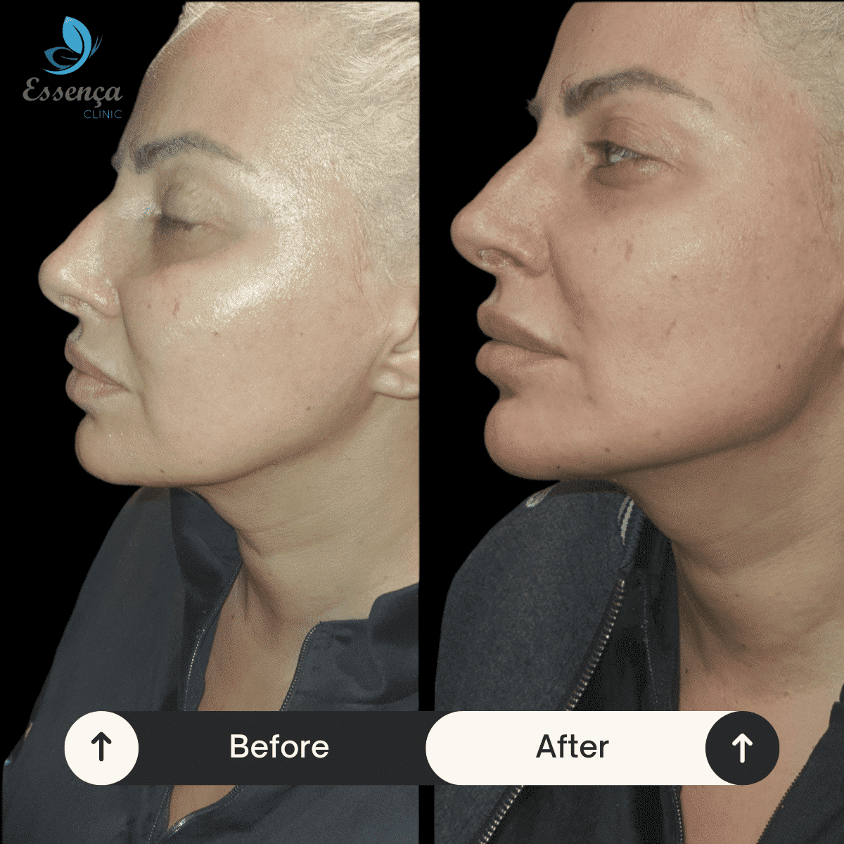 Face Lift (2)-min