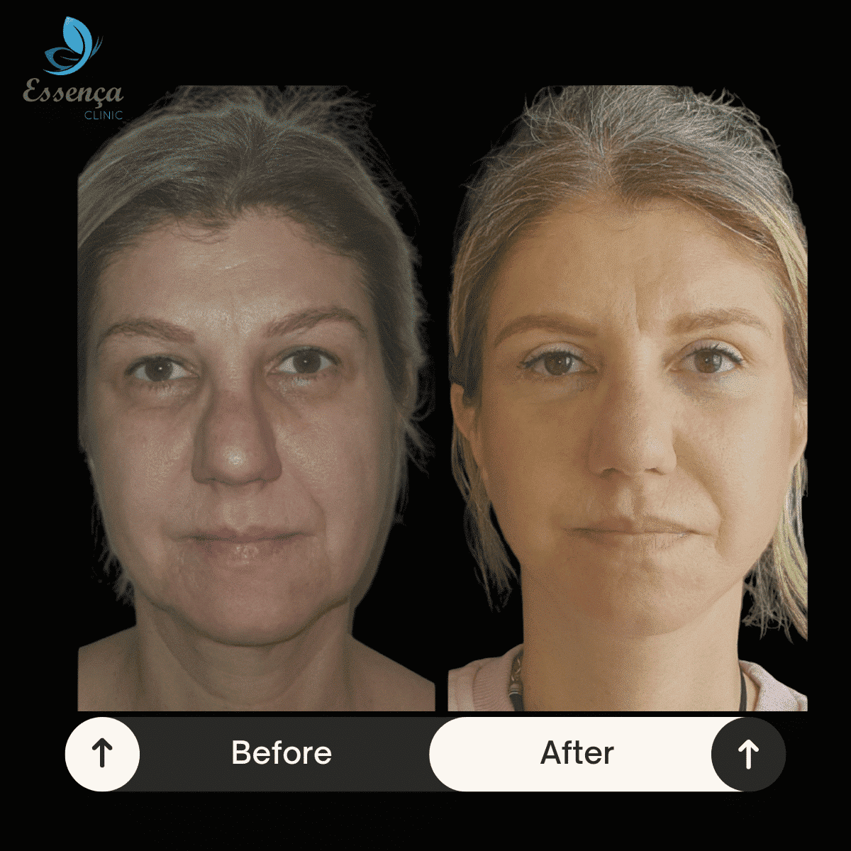 Face Lift (3)-min