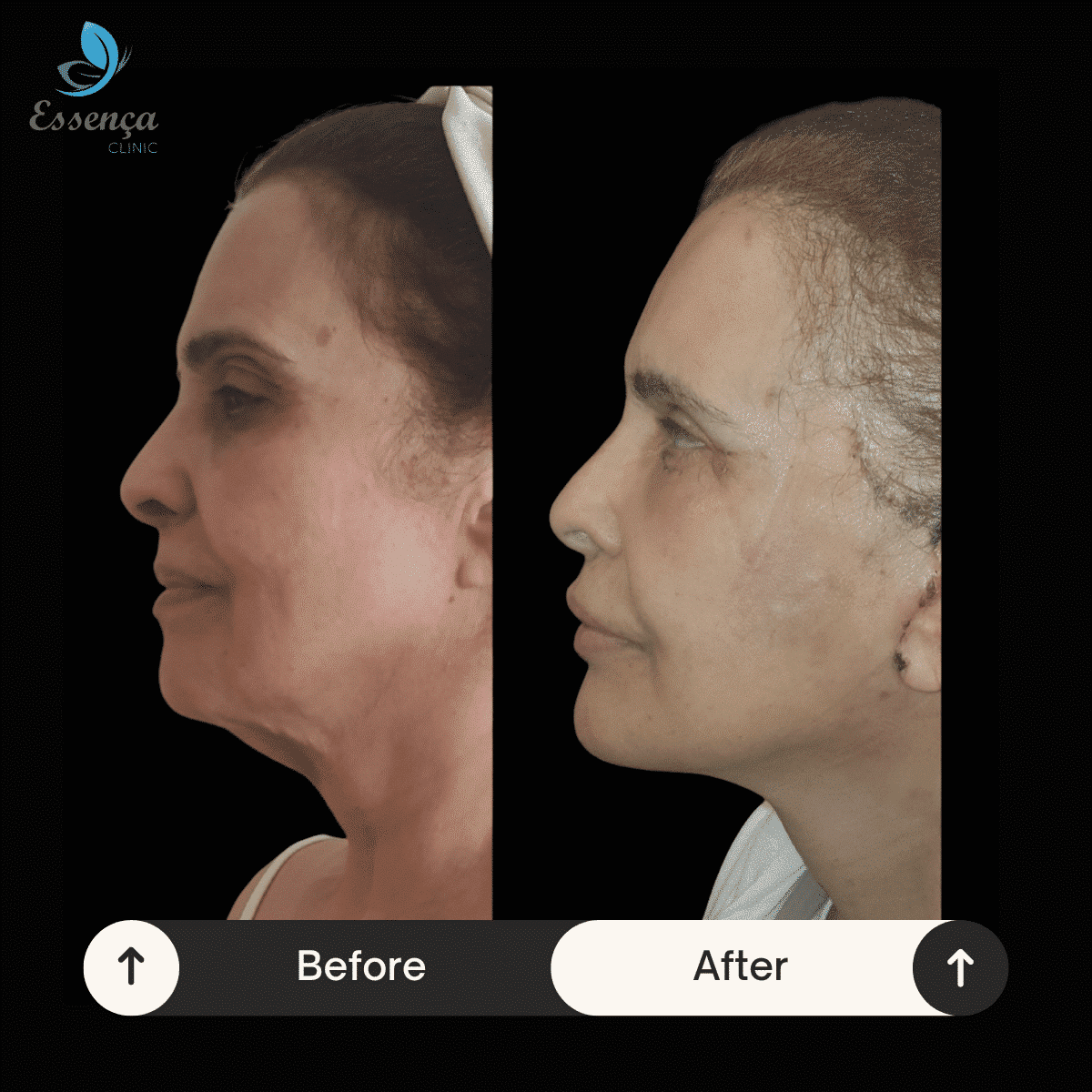 Face Lift (4)-min