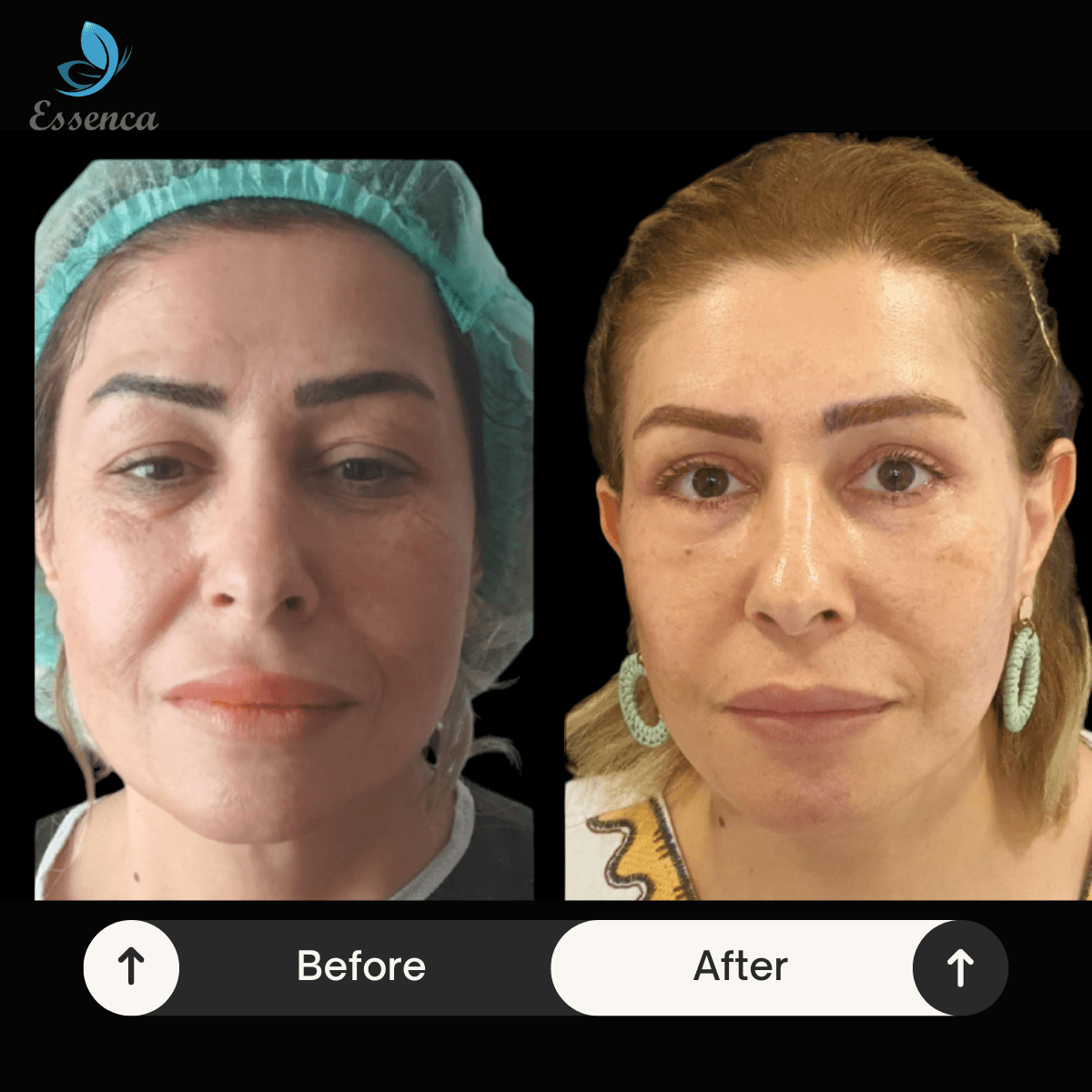 Face Lift (5)-min