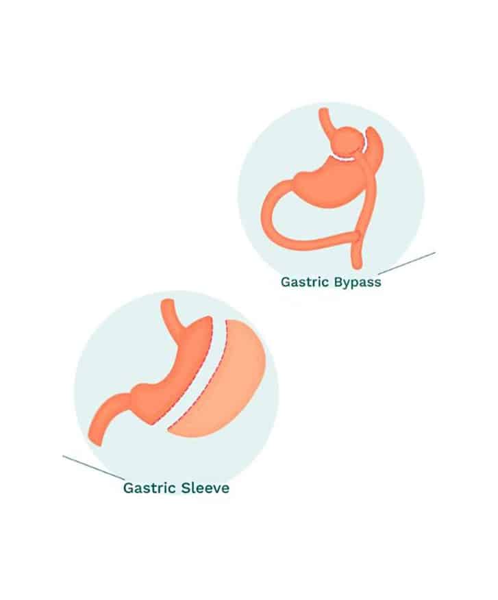 https://essencaclinic.com/wp-content/uploads/2025/01/Gastric-sleeve3-min.jpg
