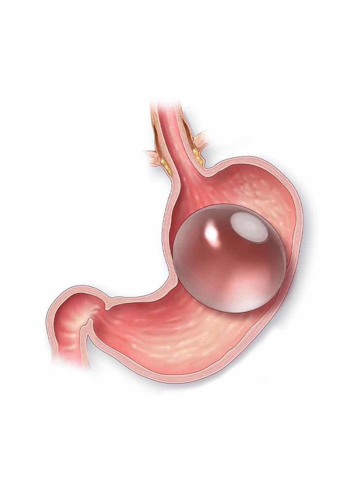 https://essencaclinic.com/wp-content/uploads/2025/01/Gastric-smart-capsule-min.jpg