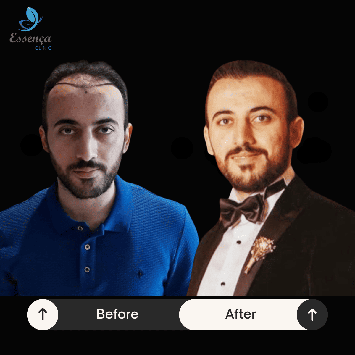 Men Hair Transplant (13)