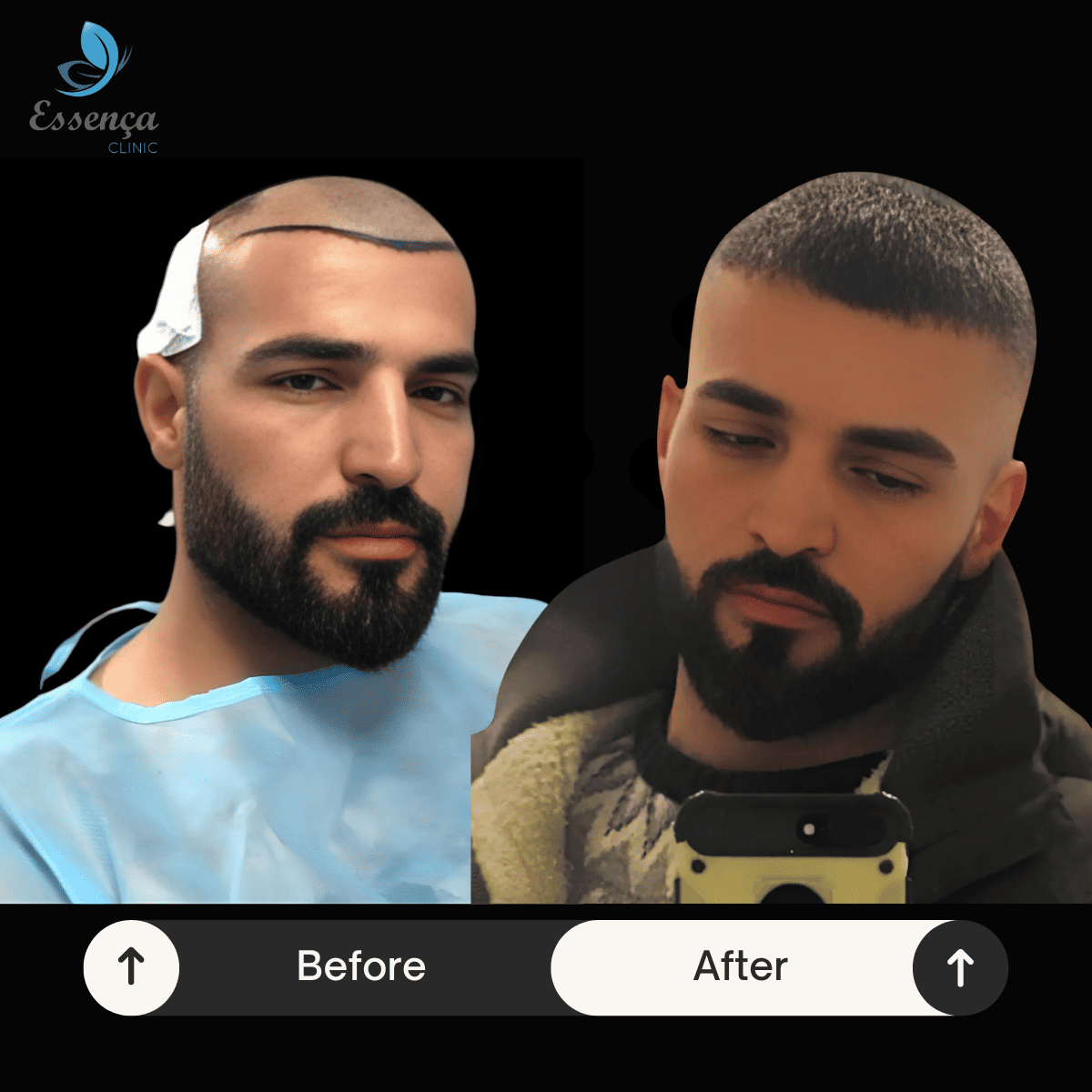 Men Hair Transplant (18)