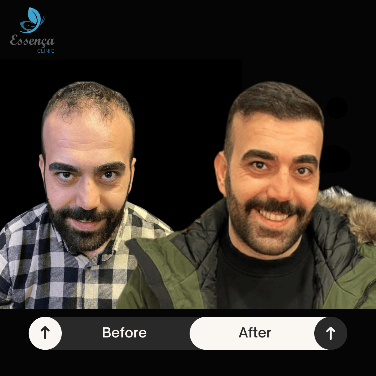Men Hair Transplant (19)