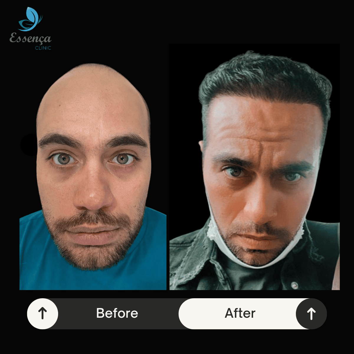 Men Hair Transplant (20)