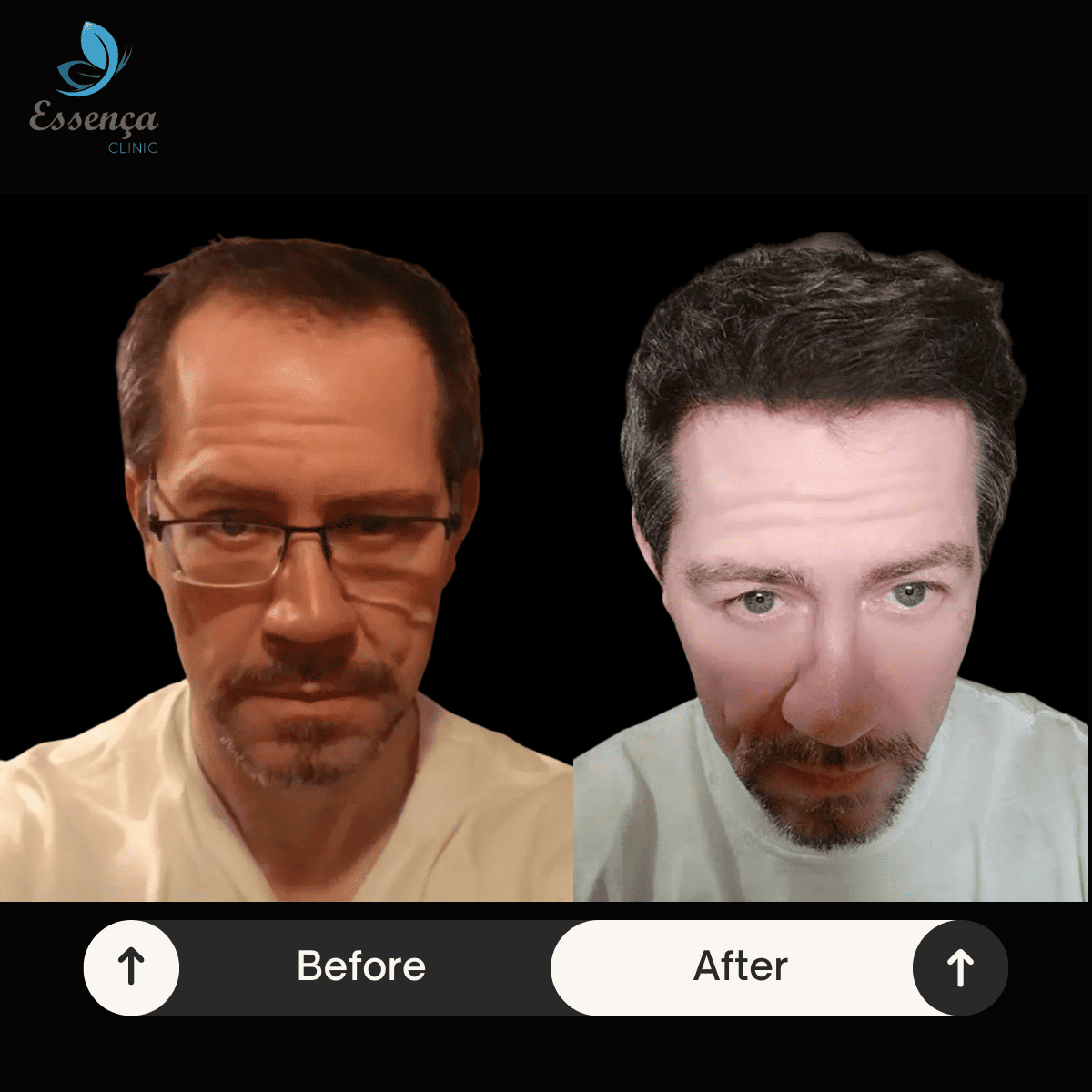 Men Hair Transplant (26)