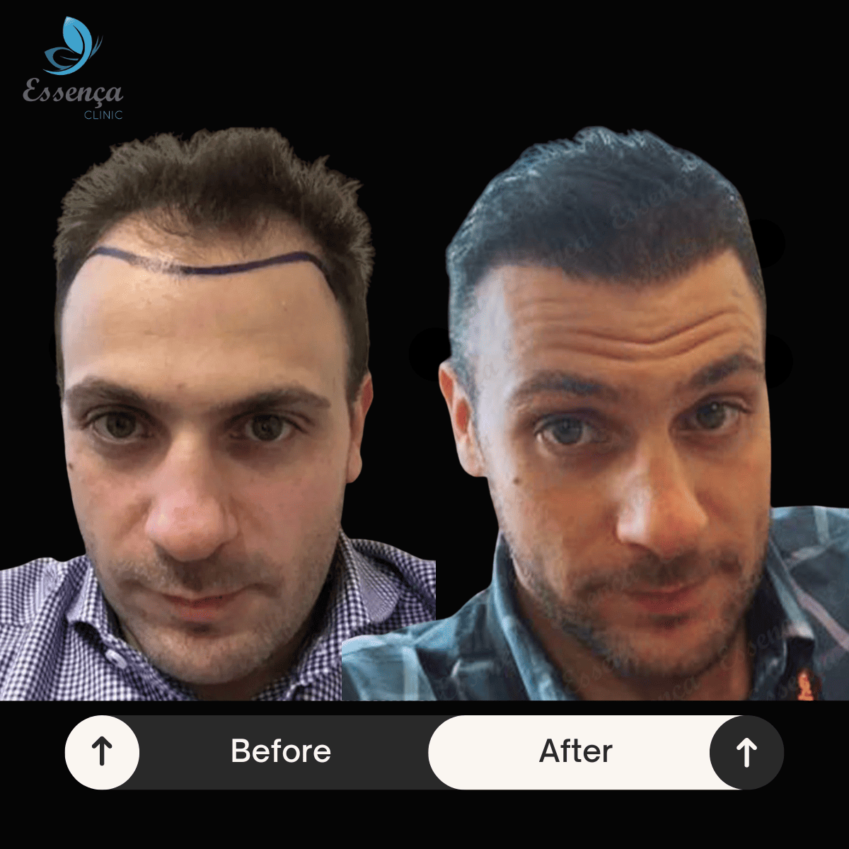 Men Hair Transplant (28)