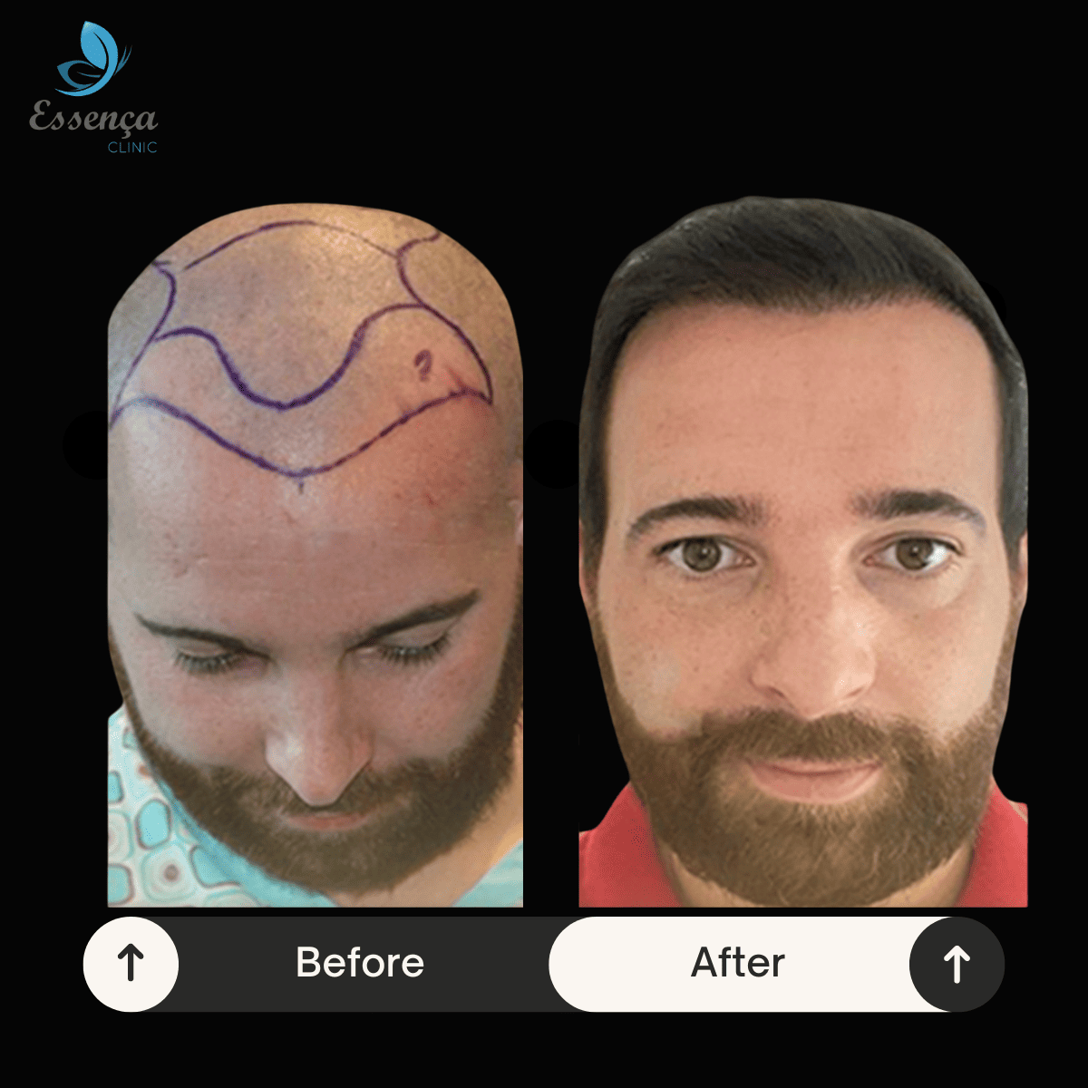 Men Hair Transplant (32)