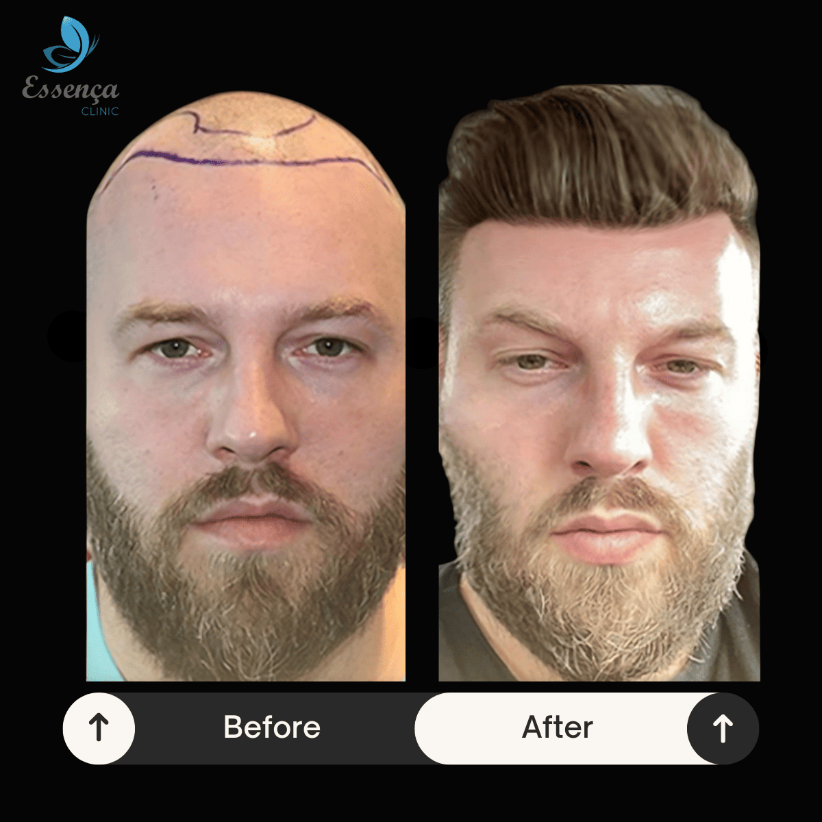 Men Hair Transplant (33)