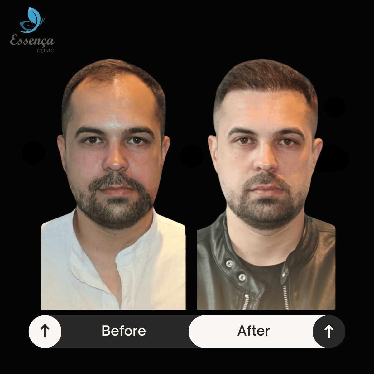 Men Hair Transplant (35)
