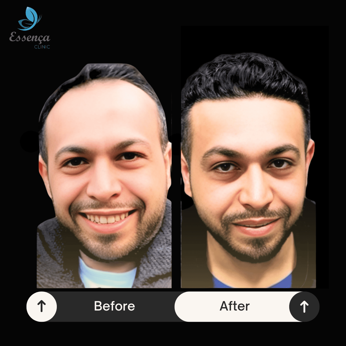 Men Hair Transplant (36)