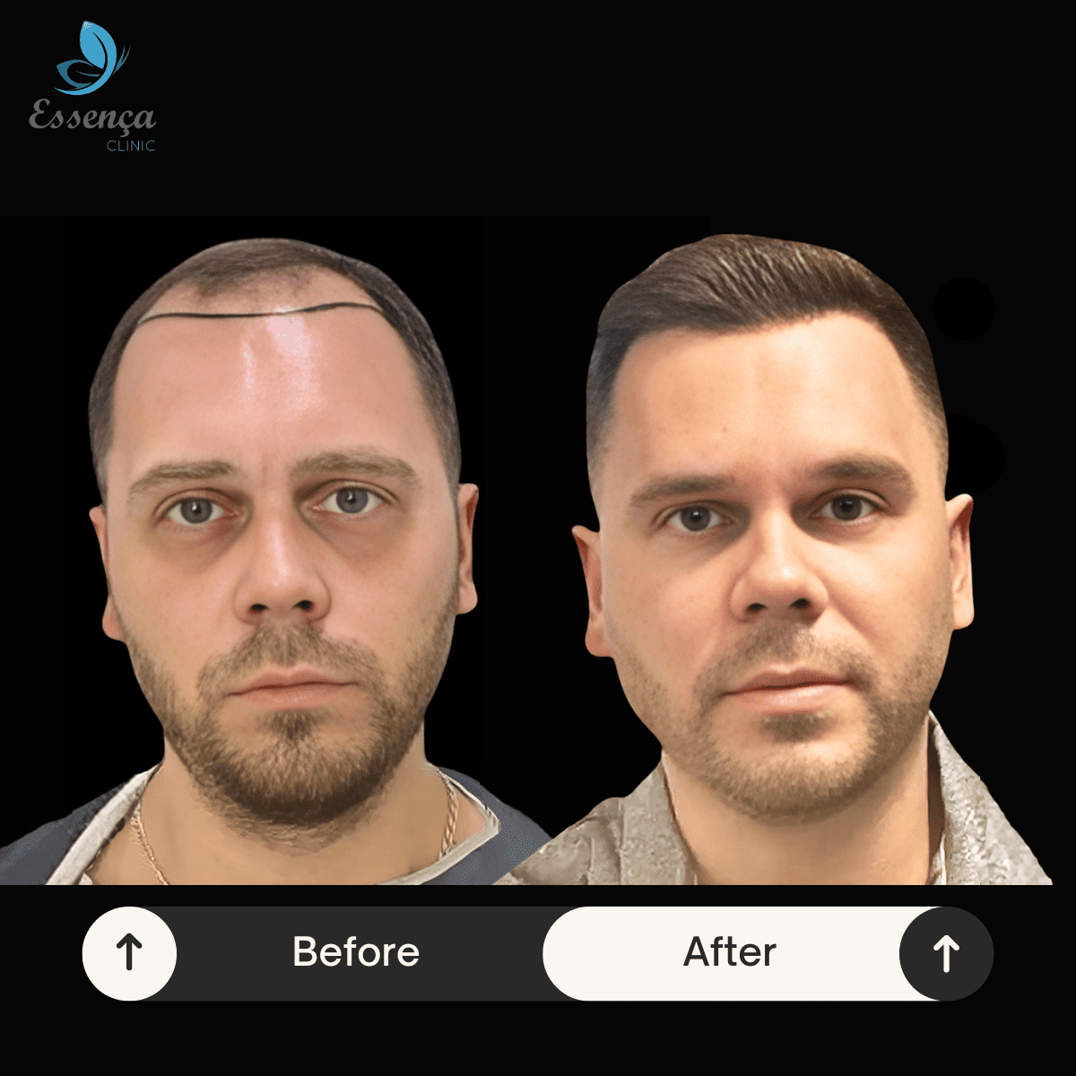 Men Hair Transplant (37)