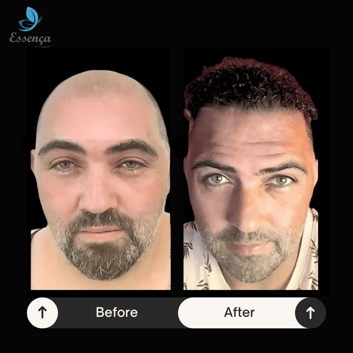 Men Hair Transplant (39)