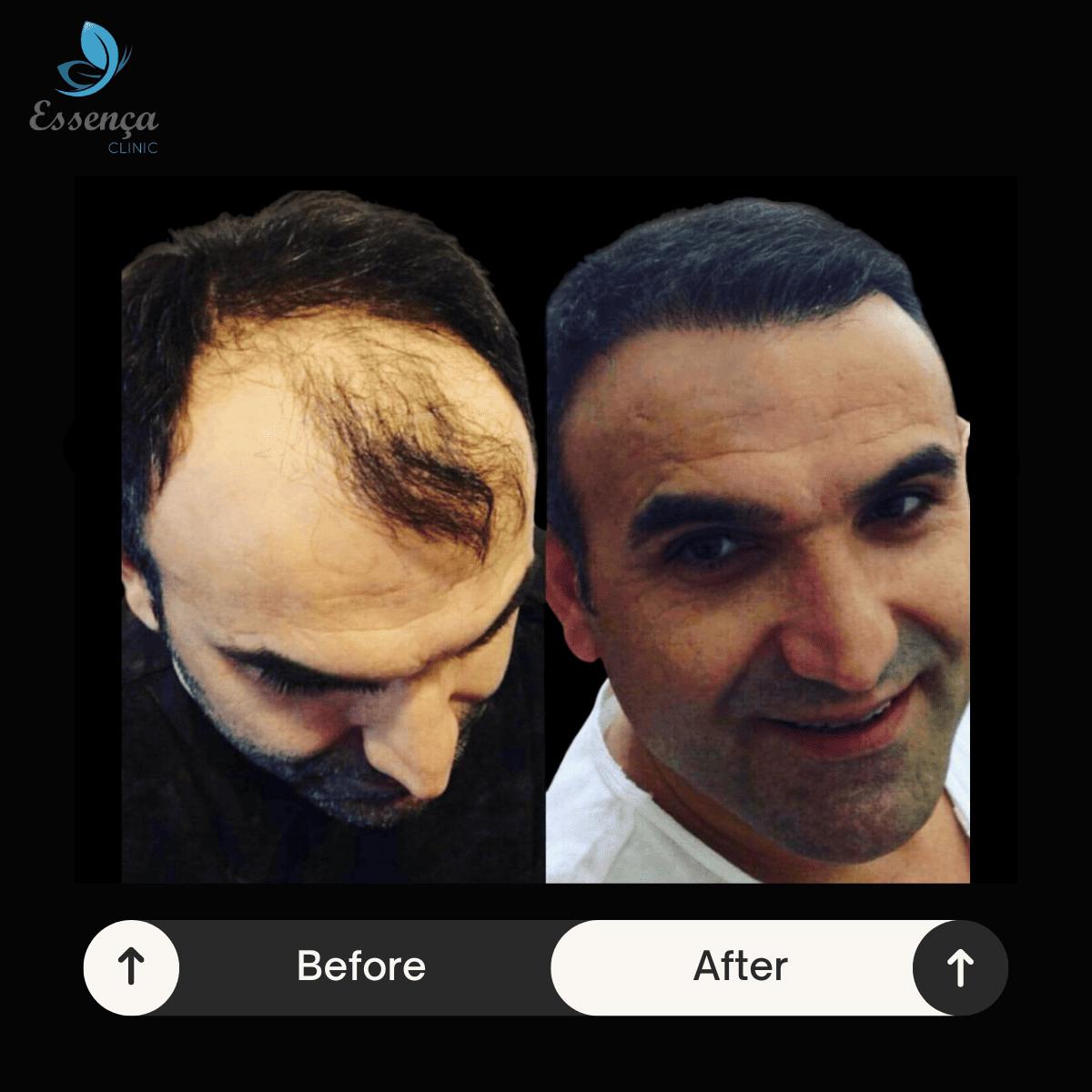 Men Hair Transplant (4)