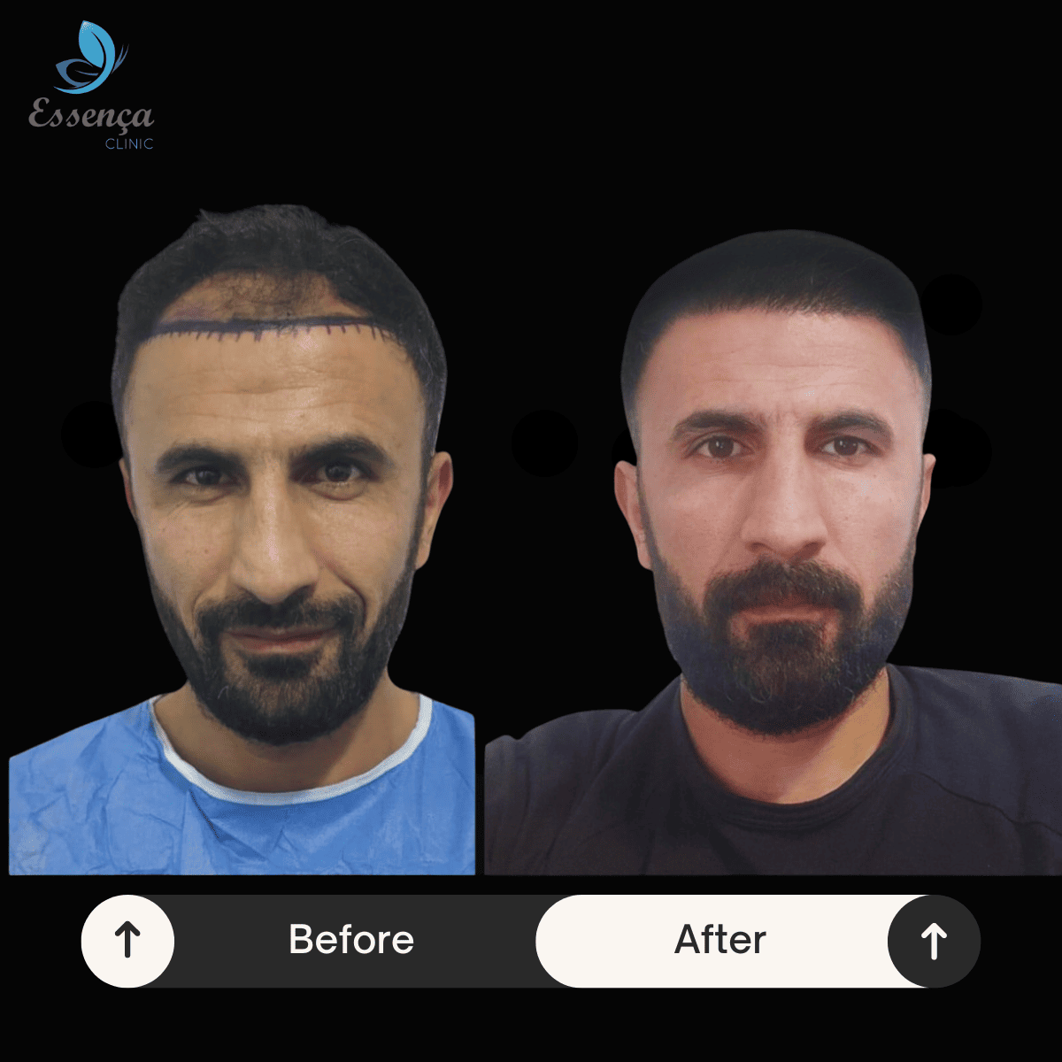 Men Hair Transplant (40)