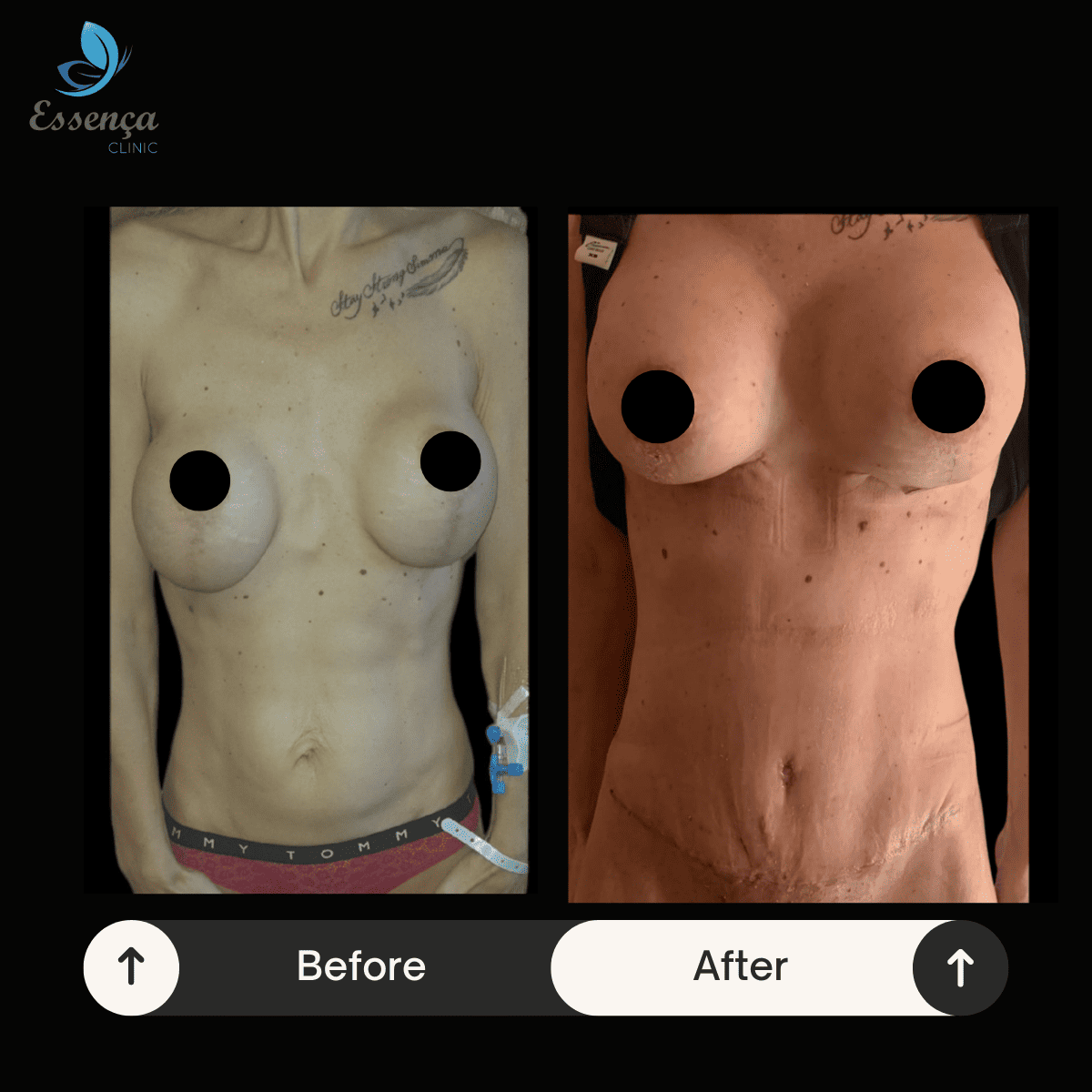 Mommy Makeover (3)