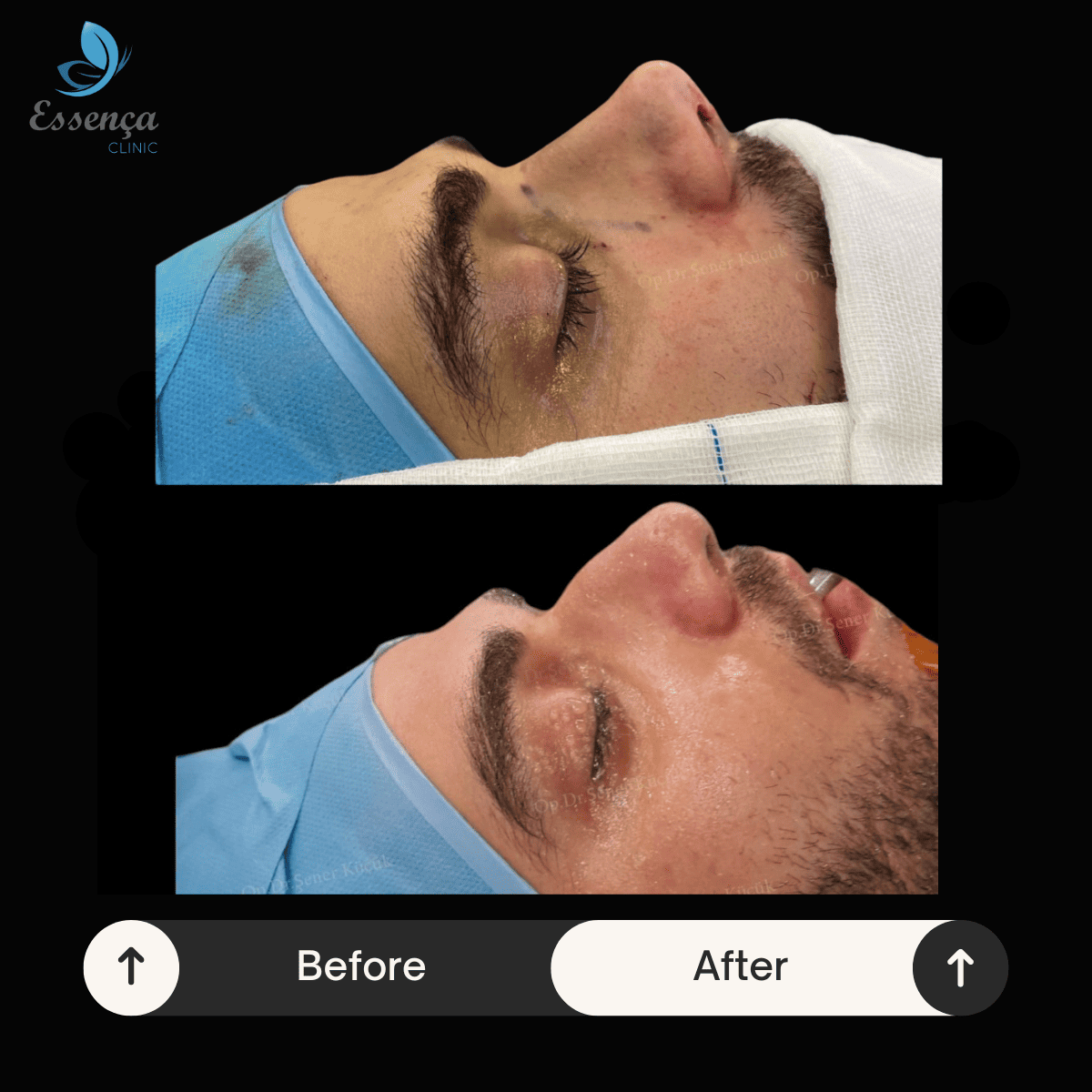 Nose Surgery - Rhinoplasty (1)