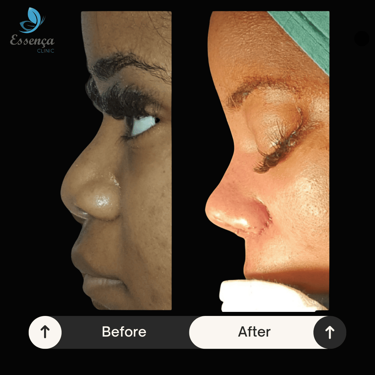Nose Surgery - Rhinoplasty (10)