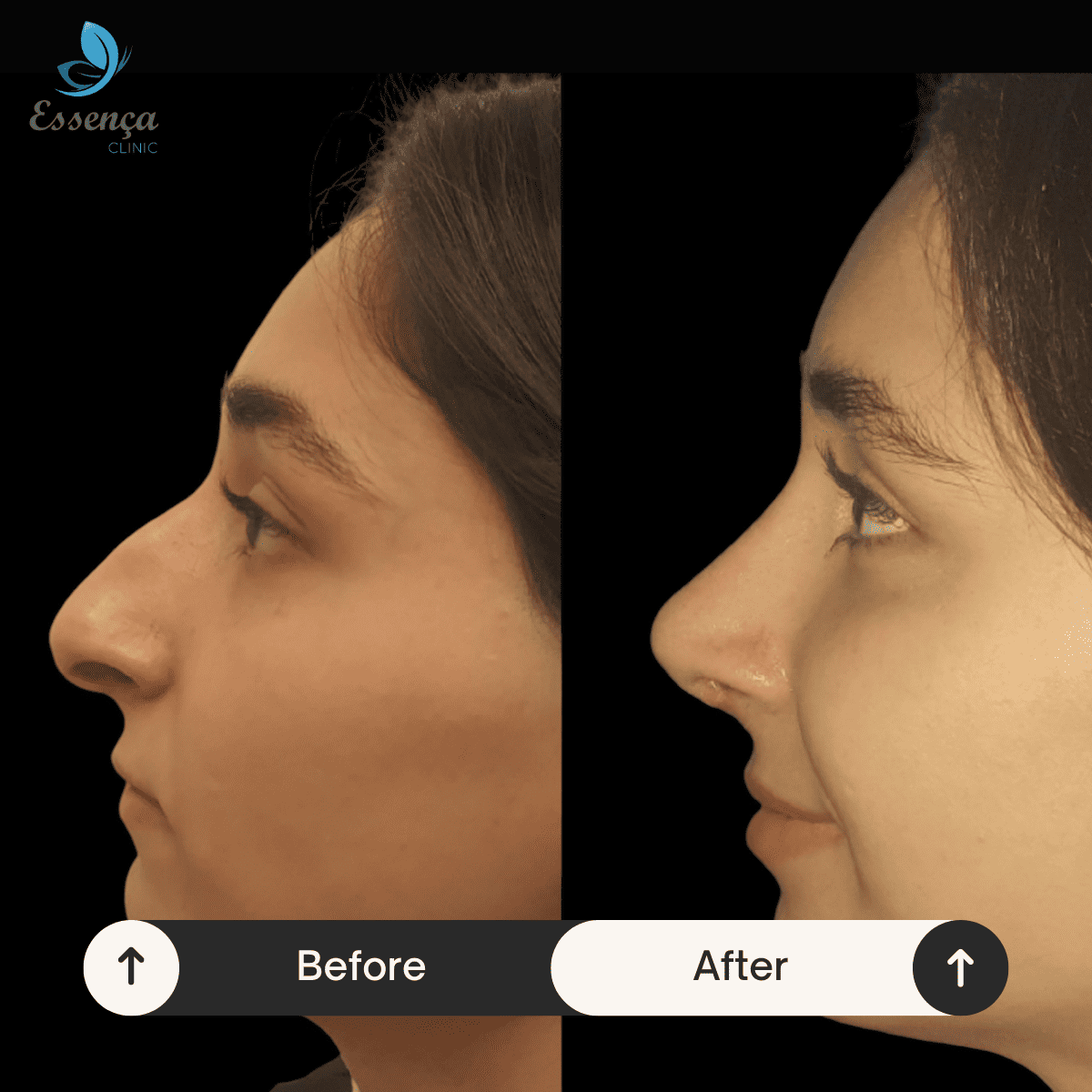 Nose Surgery - Rhinoplasty (11)