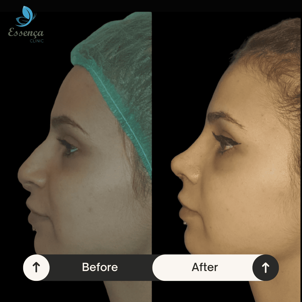 Nose Surgery - Rhinoplasty (12)